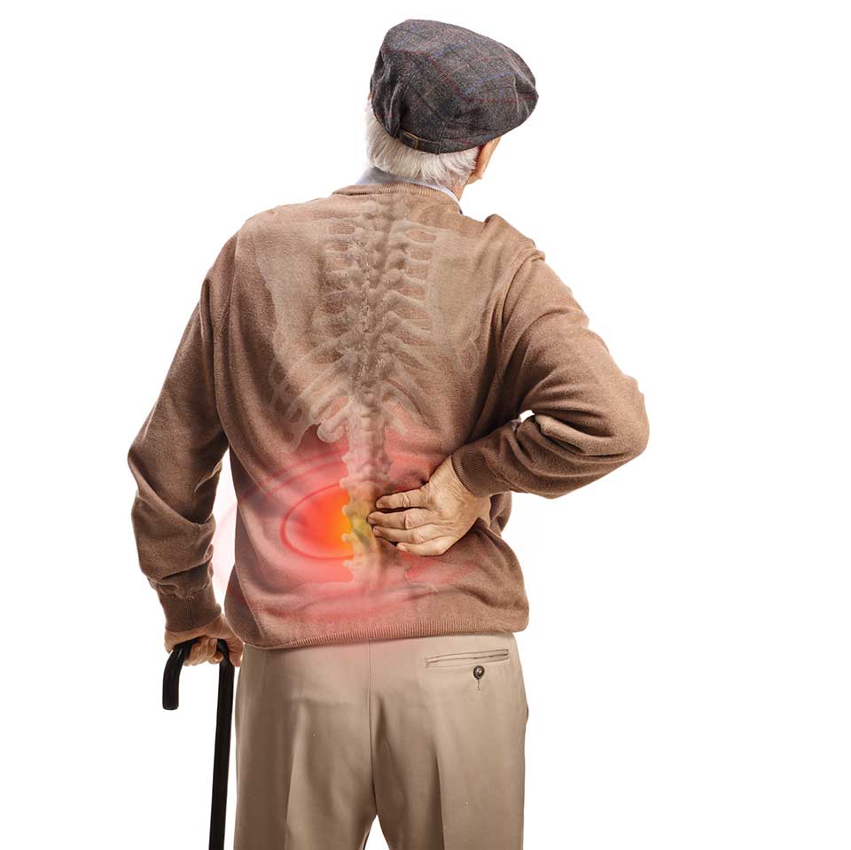 Spinal Cord Stimulator